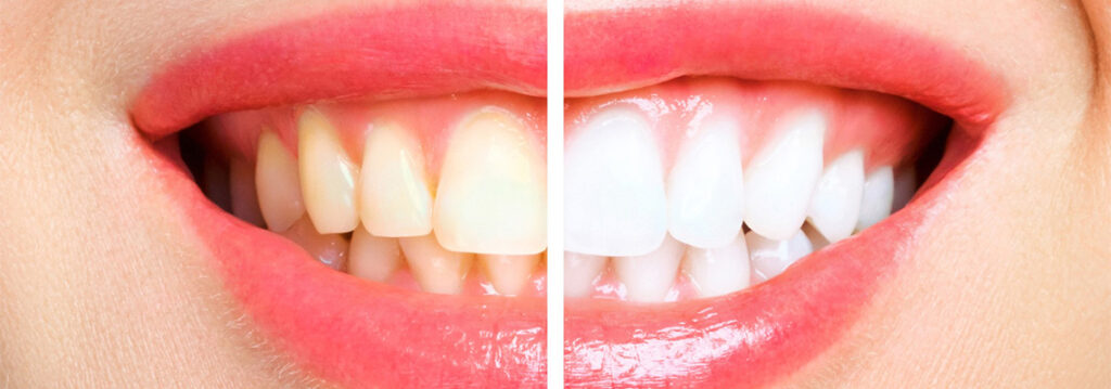 Full Smile Makeover in Turkey: What’s Included, Cost & How It Works