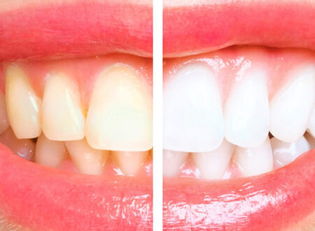 Full Smile Makeover in Turkey: What’s Included, Cost & How It Works