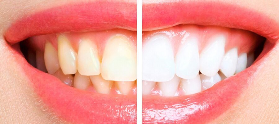 Full Smile Makeover in Turkey: What’s Included, Cost & How It Works