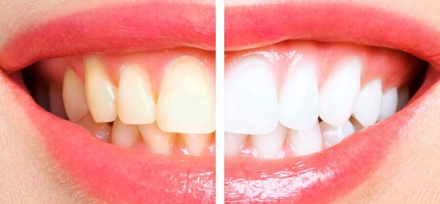 Hollywood Smile vs Veneers in Turkey – What’s the Real Difference?