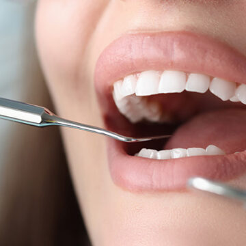 How Long Do Veneers Last? Porcelain & Zirconium Lifespan Guide (Turkey, 2025)