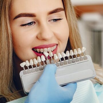 Hollywood Smile Cost in Turkey (2025) – What’s Included & Price Breakdown