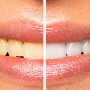 Smile Makeover in Turkey – Full Guide with Before & After Results