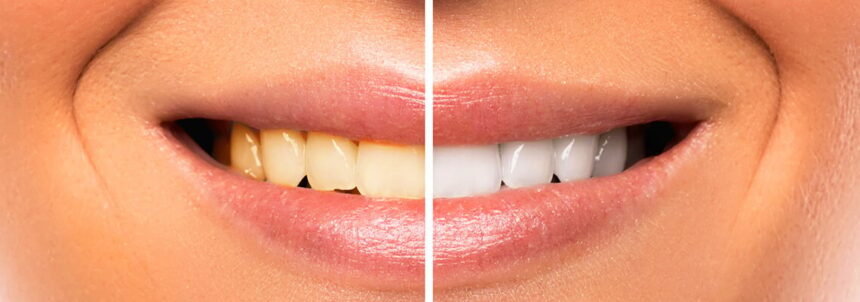 Smile Makeover in Turkey – Full Guide with Before & After Results