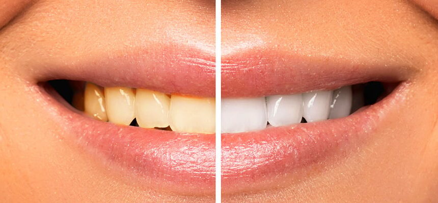 Smile Makeover in Turkey – Full Guide with Before & After Results