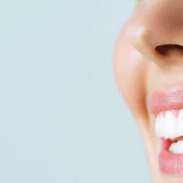 Porcelain Veneers in Turkey – Cost, Pros & Results (2025 Guide)