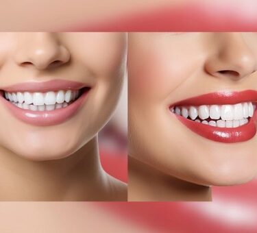 Comprehensive Guide to Dental Implant Surgery in Turkey 2025: Techniques, Costs, Risks, and Top Clinics