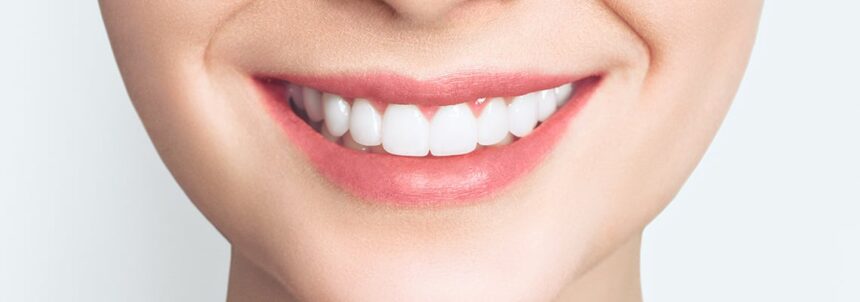 Hollywood Smile for Men in Turkey – Masculine Smile Design & Cost (2025)