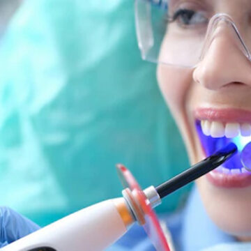 Dental Veneers in Turkey – Types, Cost & Procedure (2025 Guide)