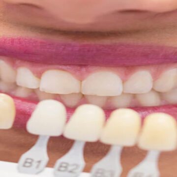 Best Dental Clinics in Turkey for Hollywood Smile – Top 2025 Guide