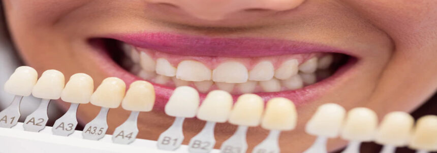Best Dental Clinics in Turkey for Hollywood Smile – Top 2025 Guide
