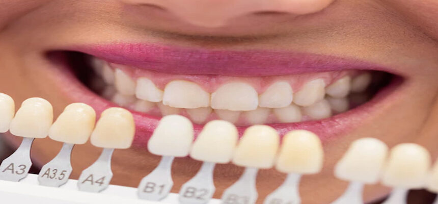 Best Dental Clinics in Turkey for Hollywood Smile – Top 2025 Guide