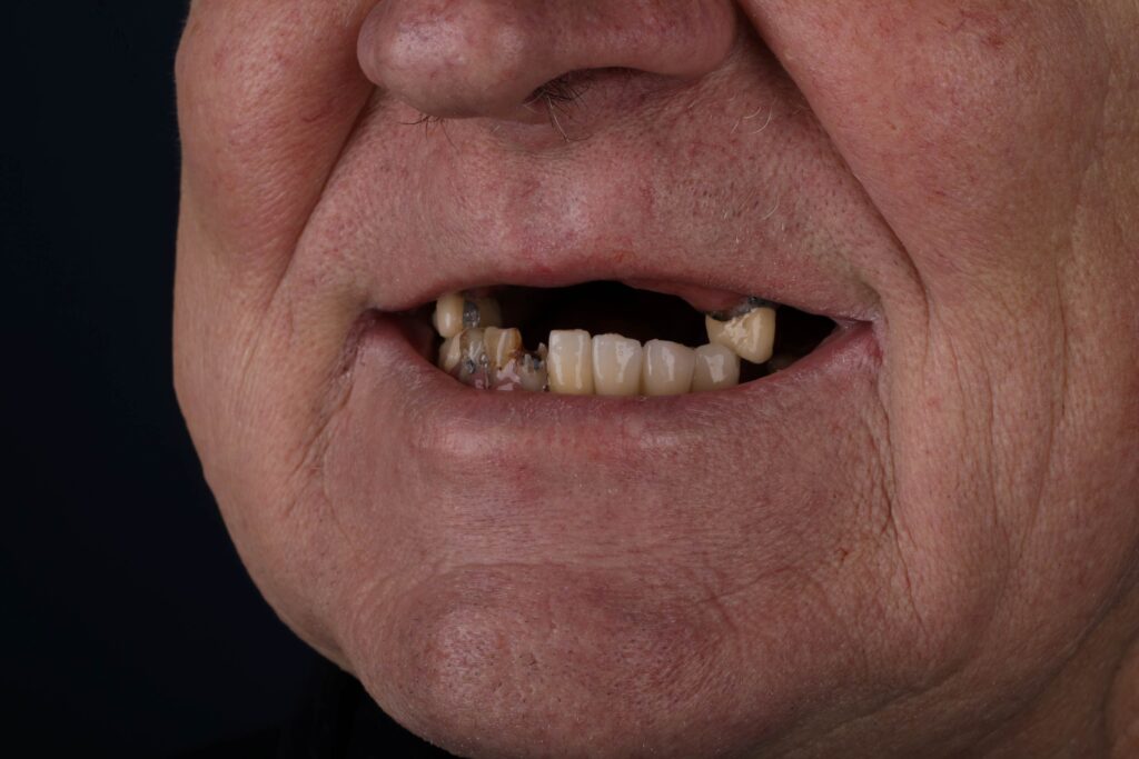 before all-on-4 dental implant