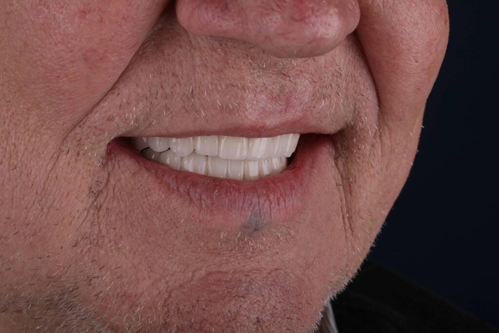after all-on-4 dental implant