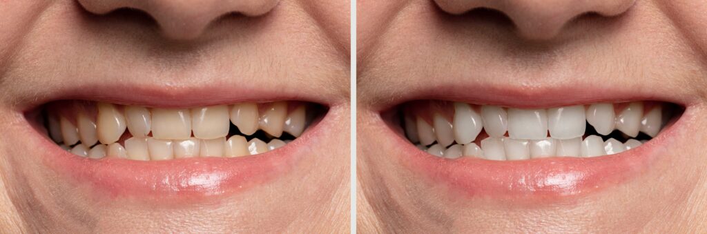 Before-and-after close-up of a smile makeover with veneers.