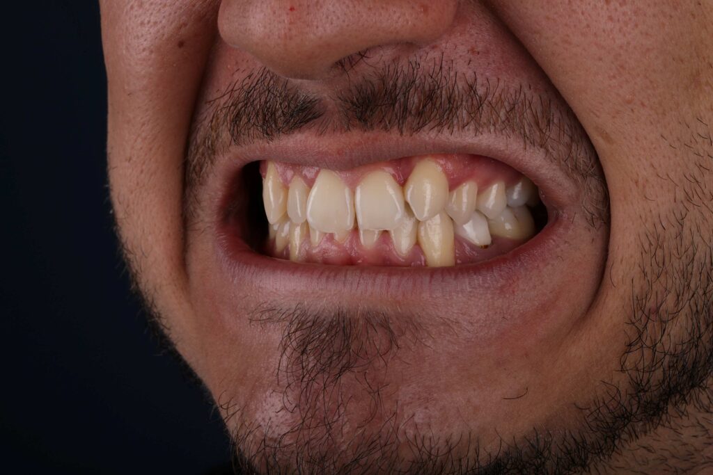 before Smile Makeover in Turkey