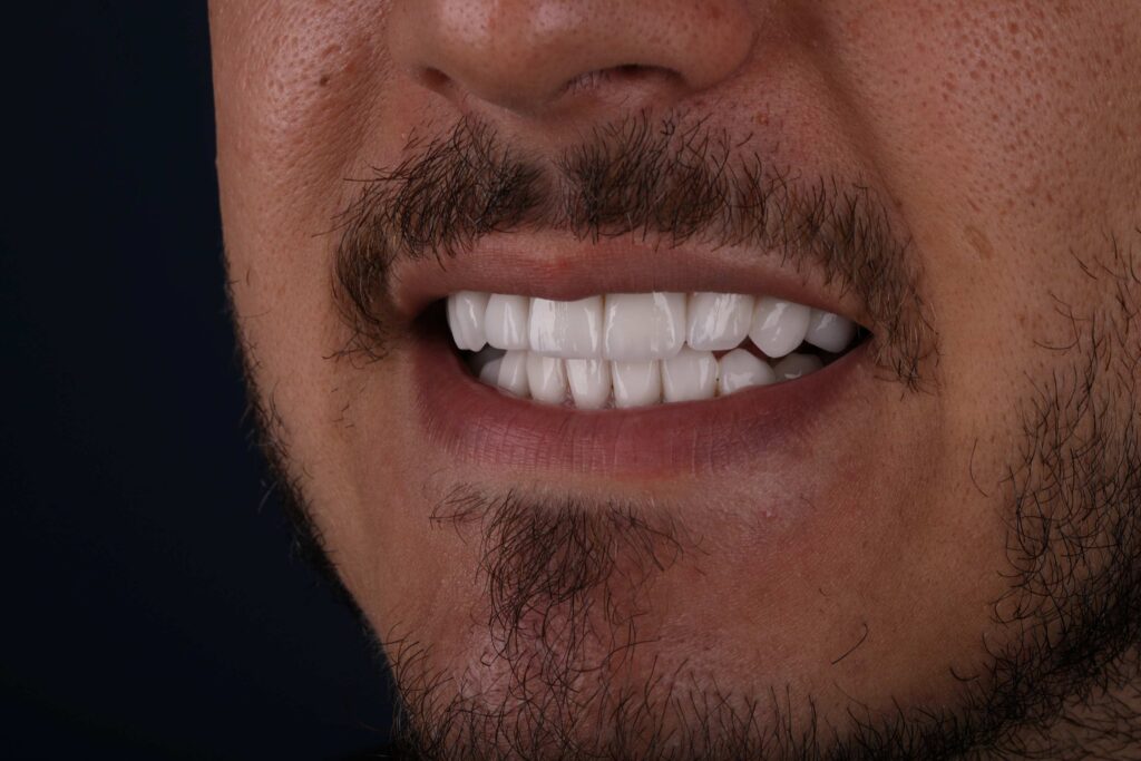 after Smile Makeover in Turkey