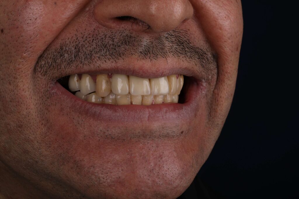 before hollywood smile in turkey dental clinic