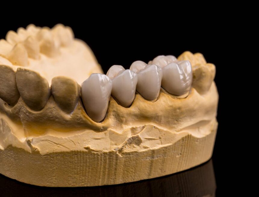 ceramic-dentures-2025-02-22-11-16-17-utc zirconia veneers turkey cost